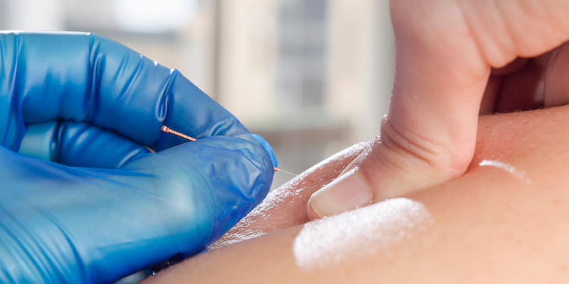 Dry Needling in Mooresville, North Carolina